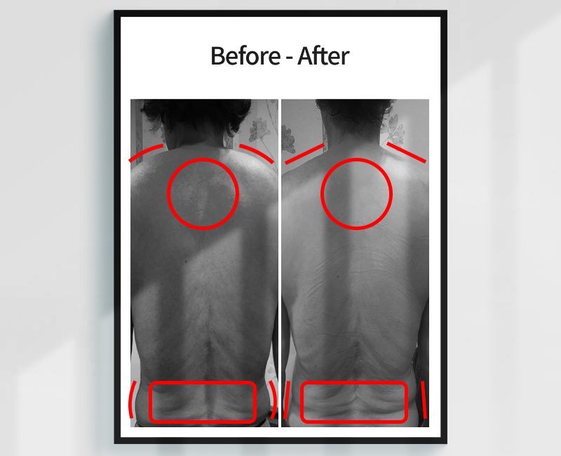 Before/After - 자세 교정 사례