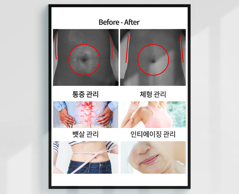 Before/After - 복부 관리 사례